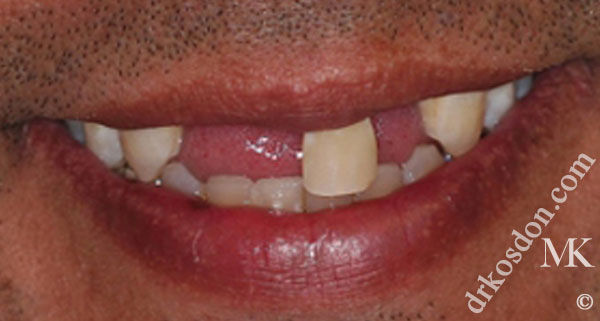 Porcelain Veneers Photos NYC - Smile Before Men Patient 18