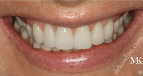 porcelain veneers after