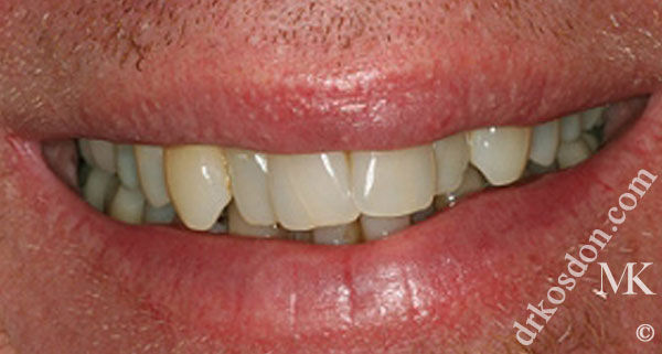 porcelain veneers before