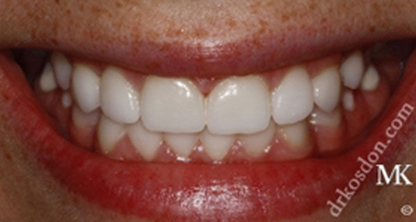 porcelain veneers after