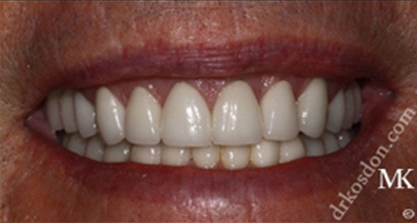 porcelain veneers after