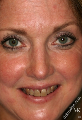 Porcelain Veneers Before