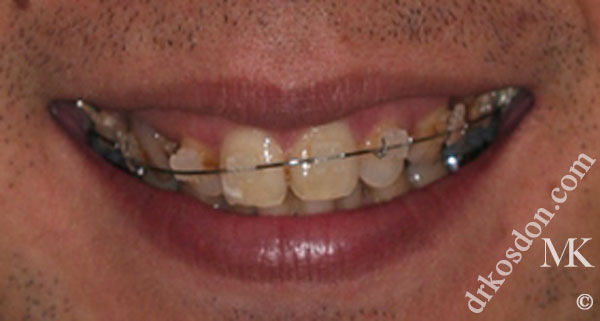 porcelain veneers before