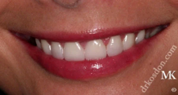 porcelain veneers after