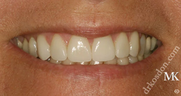 porcelain veneers after