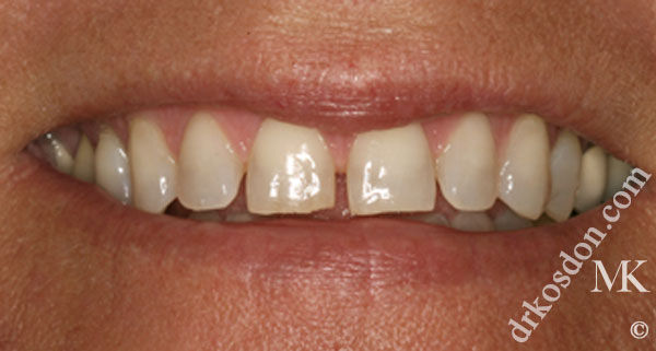 porcelain veneers before