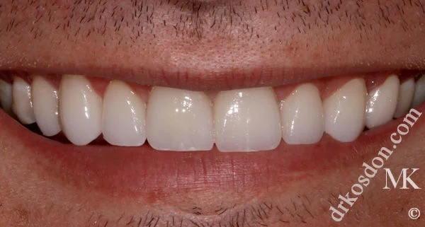 porcelain veneers after