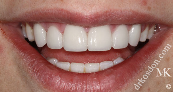 porcelain veneers after