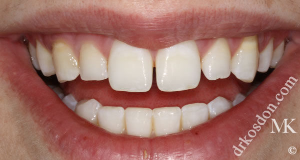 porcelain veneers before