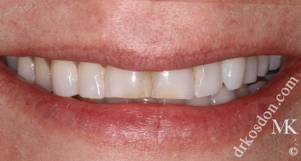 porcelain veneers before