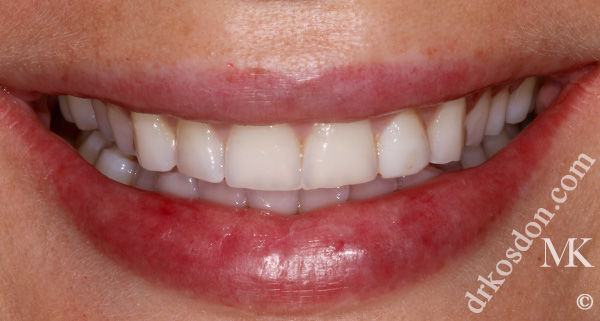 porcelain veneers before