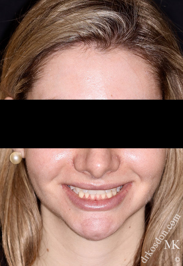 porcelain veneers before