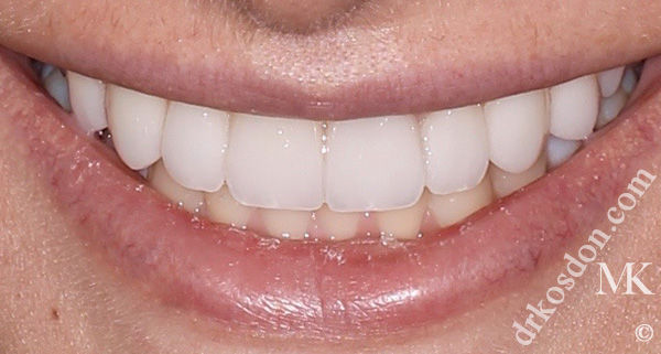 porcelain veneers after