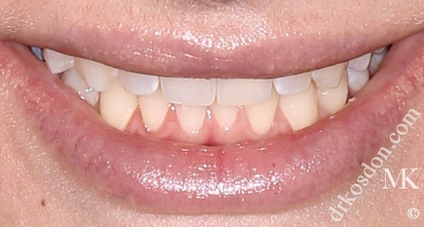 Porcelain Veneers Photos NYC - Smile Before Women Patient 55
