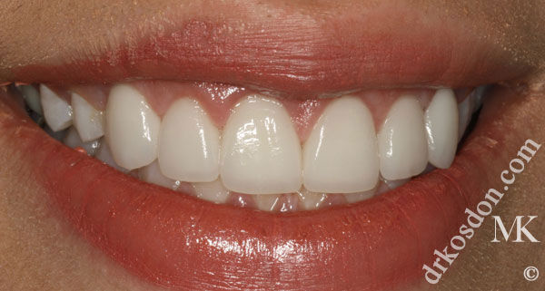 porcelain veneers after