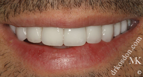 porcelain veneers after