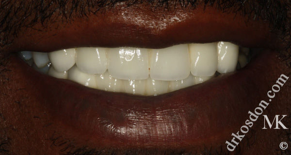 porcelain veneers after