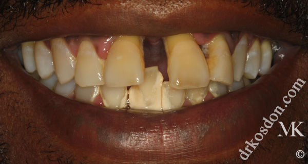 porcelain veneers before