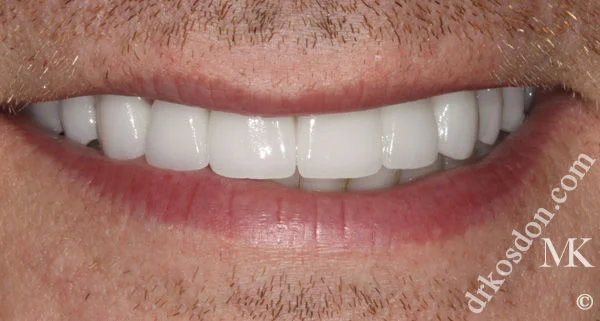 porcelain veneers after