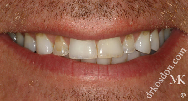 porcelain veneers before