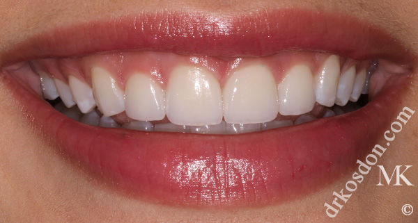 porcelain veneers after