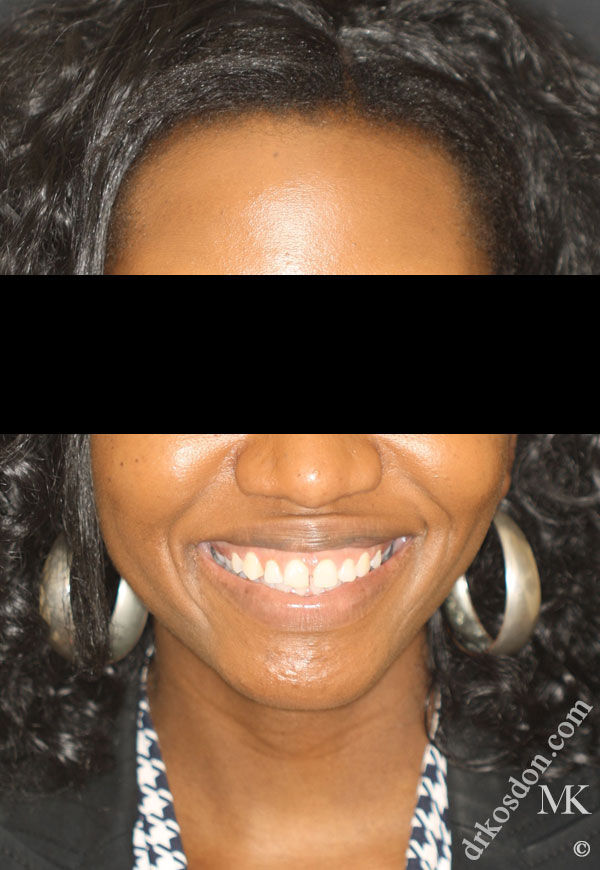 porcelain veneers before