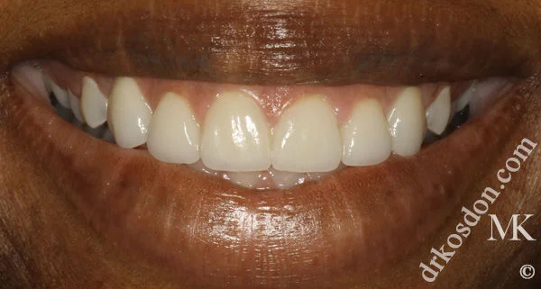 porcelain veneers after