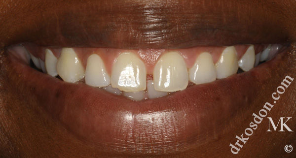 porcelain veneers before