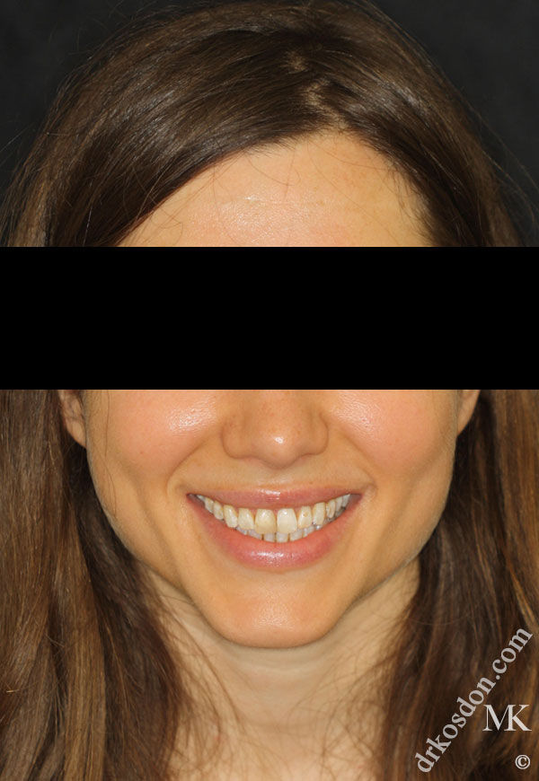 porcelain veneers before