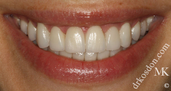 porcelain veneers after