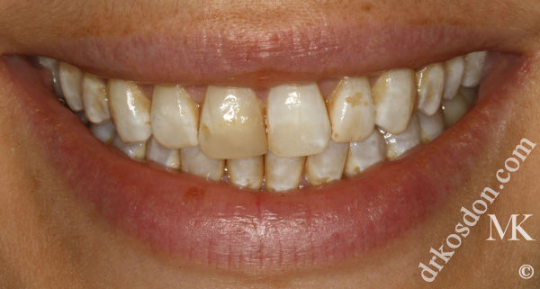 porcelain veneers before