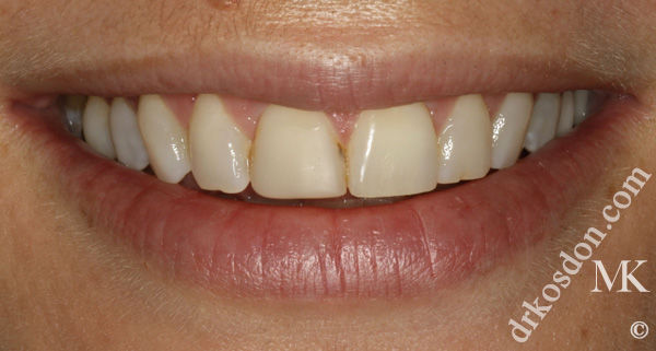 Porcelain Veneers Photos NYC - Smile Before Women Patient 35