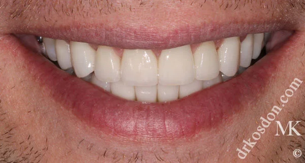 porcelain veneers after