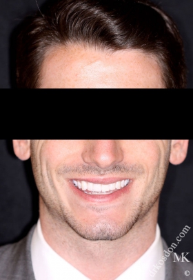 Porcelain Veneers After