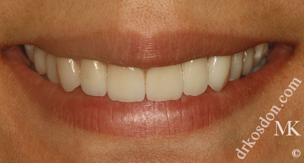 porcelain veneers after