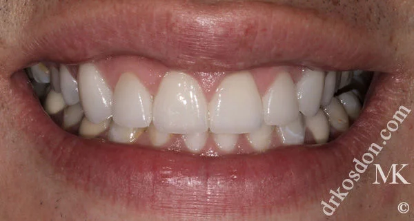 porcelain veneers after