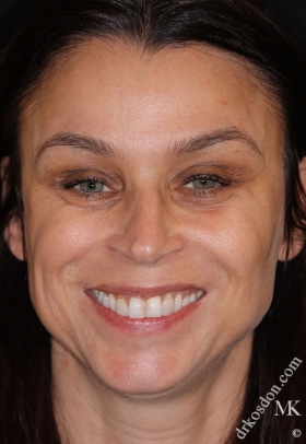 Porcelain Veneers Before