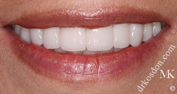 porcelain veneers after