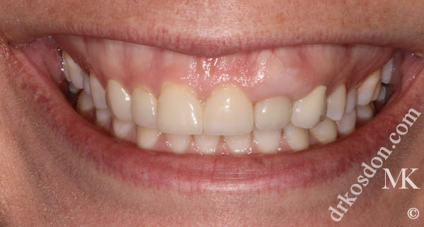 porcelain veneers before