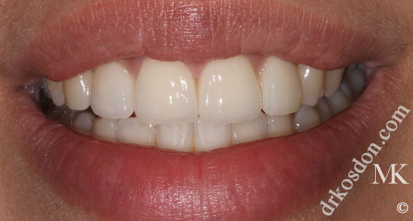 porcelain veneers after