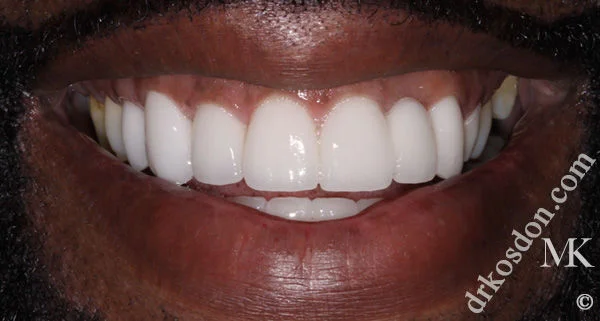 porcelain veneers after