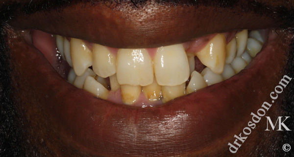 porcelain veneers before