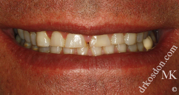 Porcelain Veneers Photos NYC - Smile Before Men Patient 22