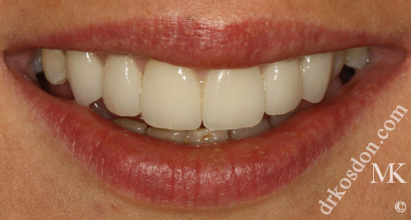 porcelain veneers after