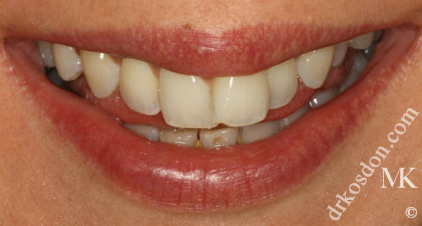 porcelain veneers before