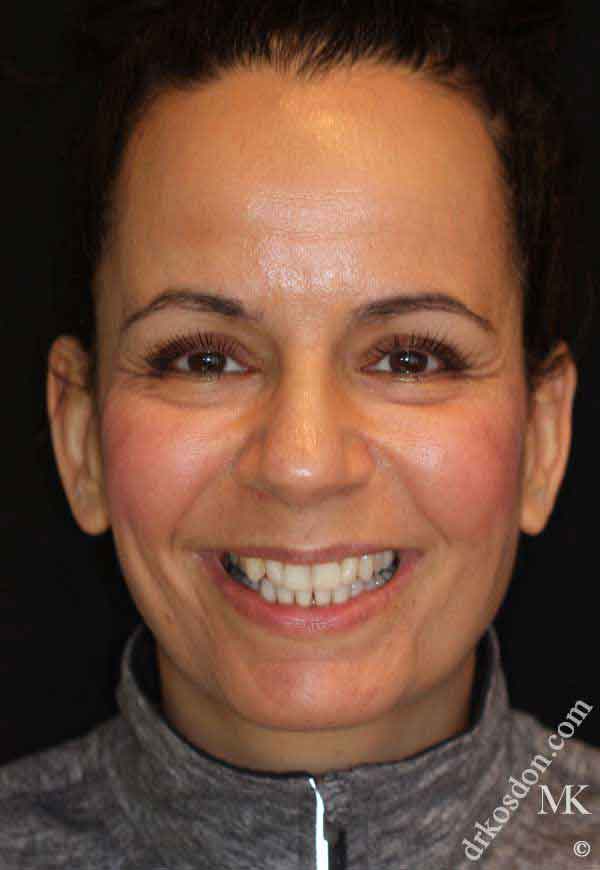 Porcelain Veneers Photos NYC - Portrait Before Women Patient 50