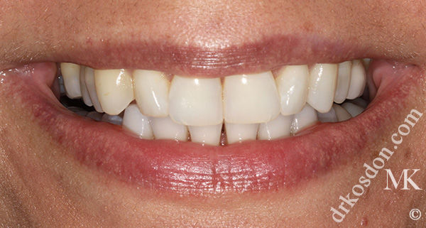 porcelain veneers before