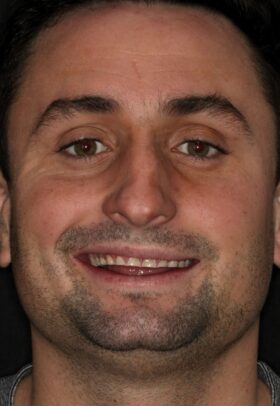 Porcelain Veneers Before
