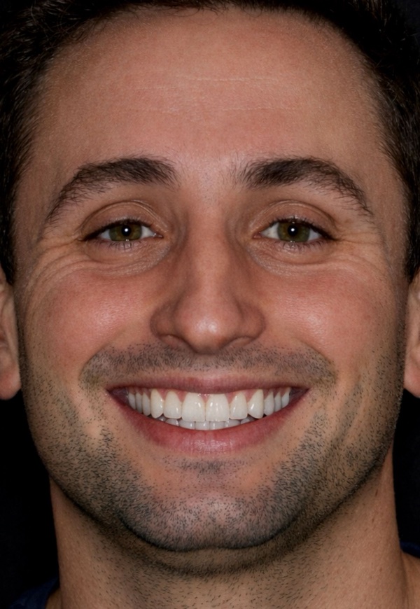 porcelain veneers after