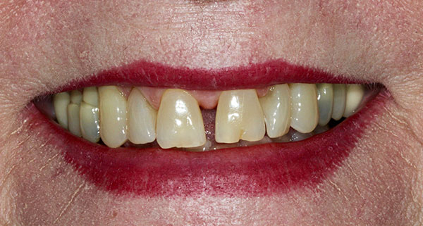 porcelain veneers before